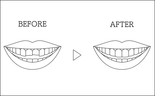 Dental Bonding
