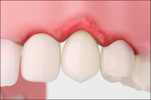 gingivitis