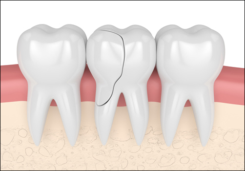 Tooth Pain