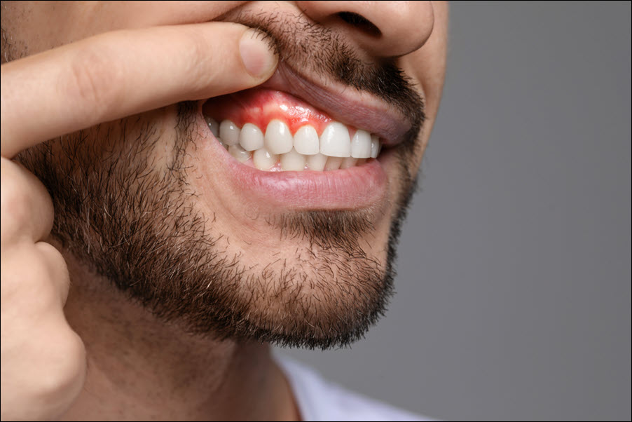 gingivitis